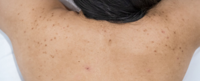 Back acne