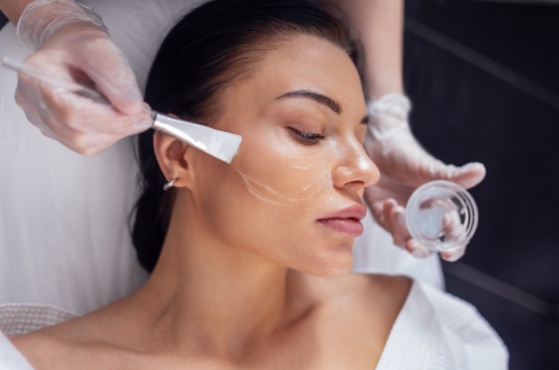 Chemical Peels