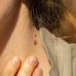 Your Skin Tags Might Be Trying to Tell You Something