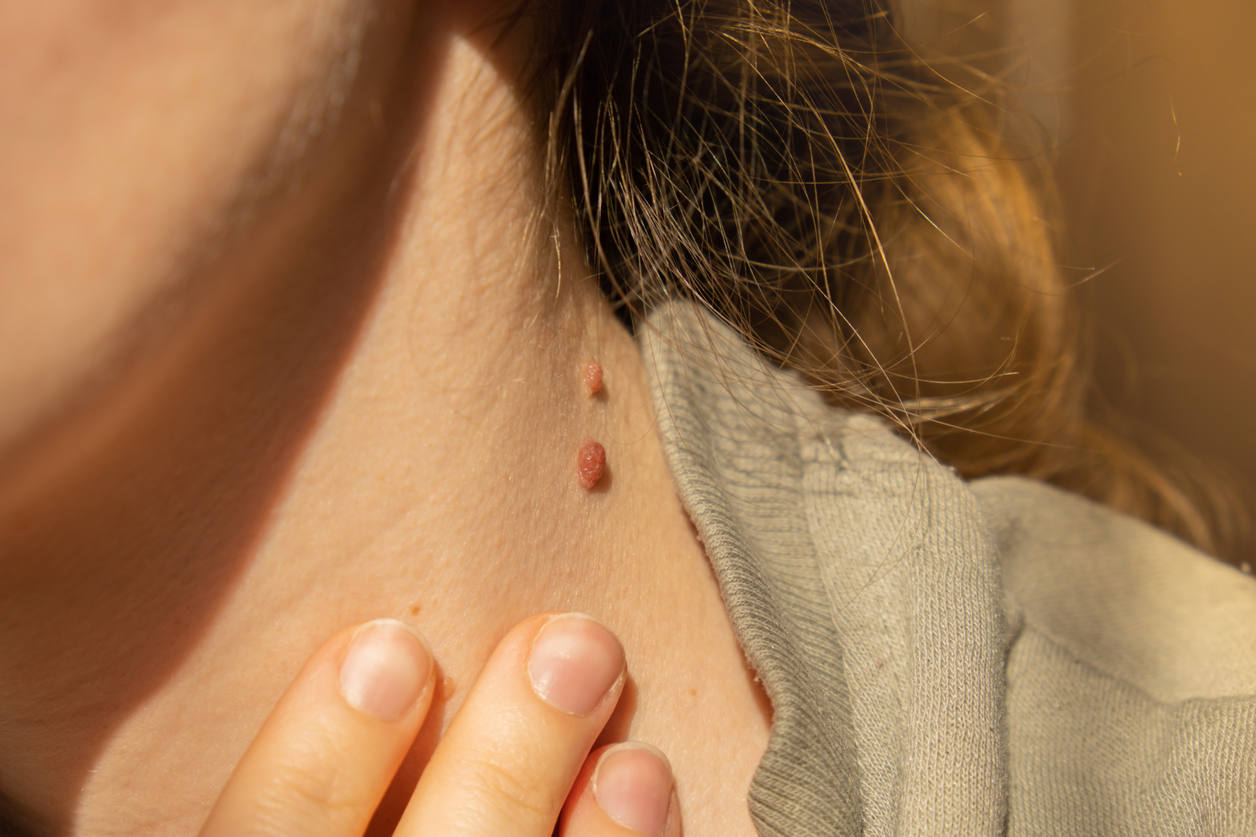 Your Skin Tags Might Be Trying to Tell You Something