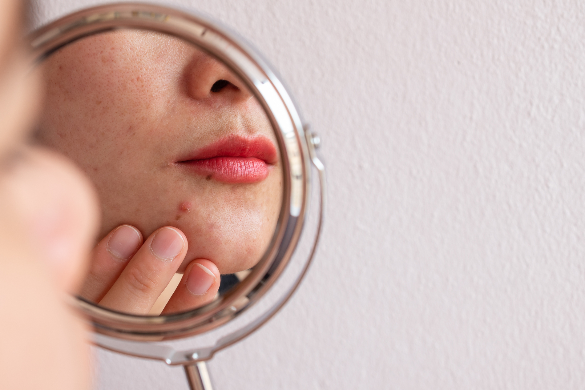 acne on face