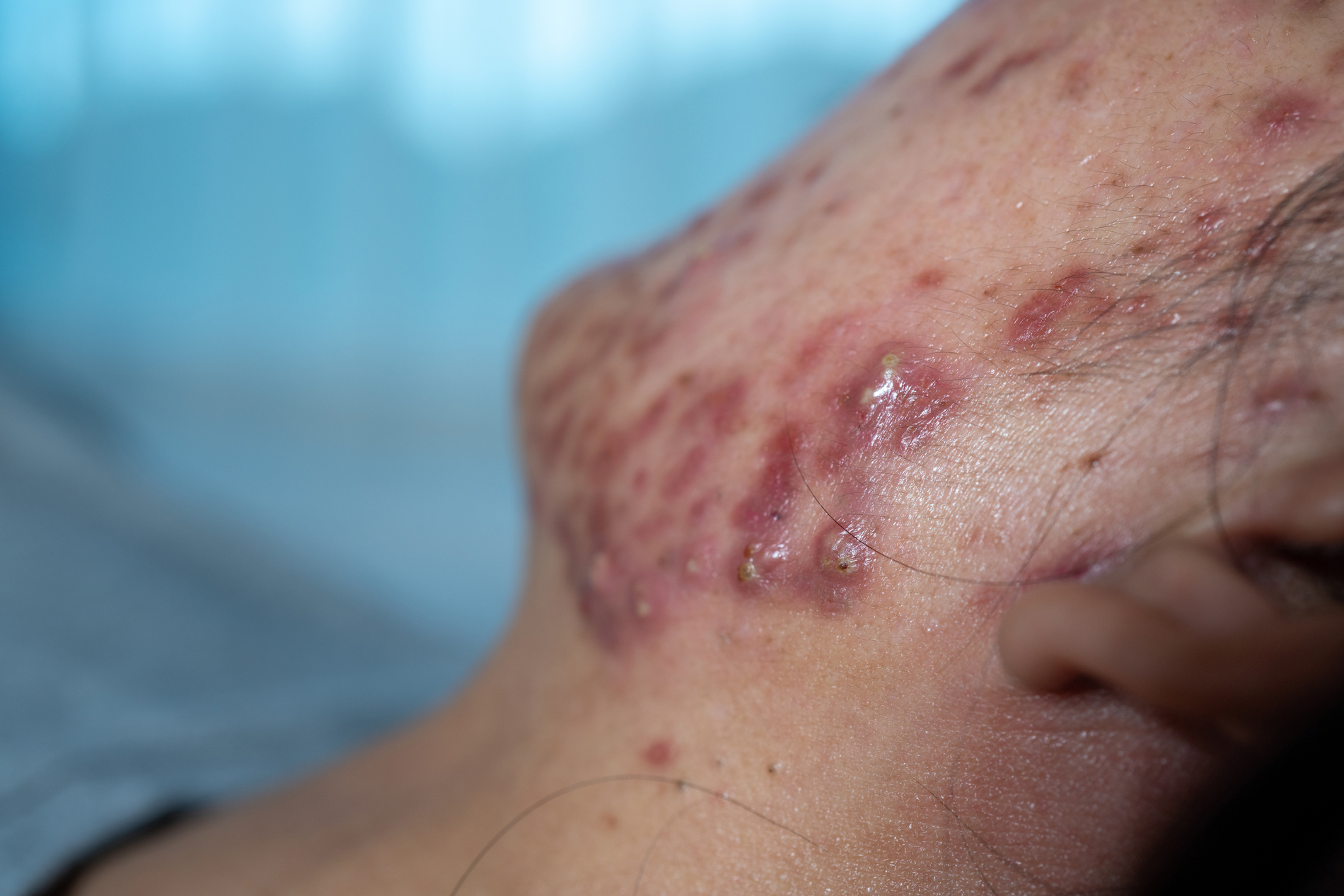 Skin Issues