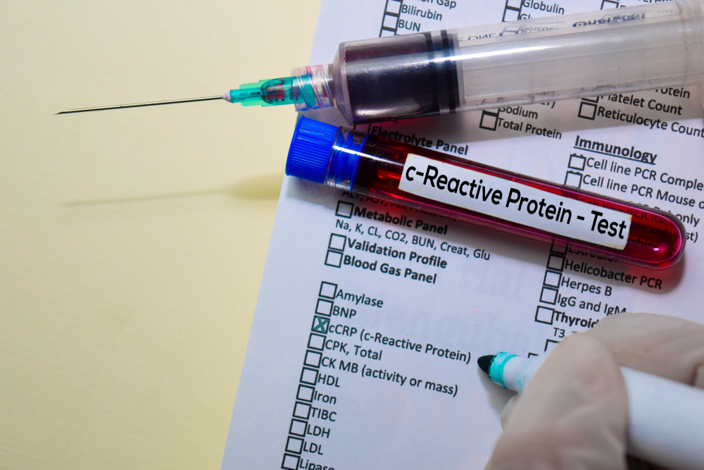 C-Reactive Protein (CRP or hs-CRP)