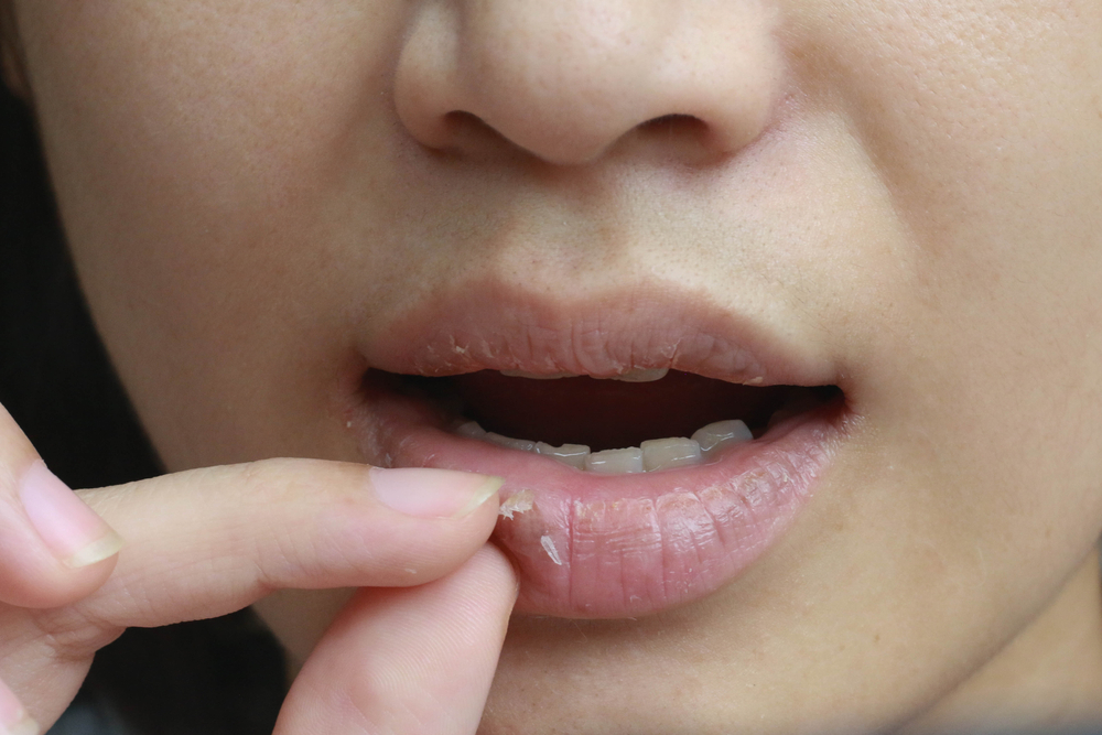 Don’t Peel or Bite Flaky Skin