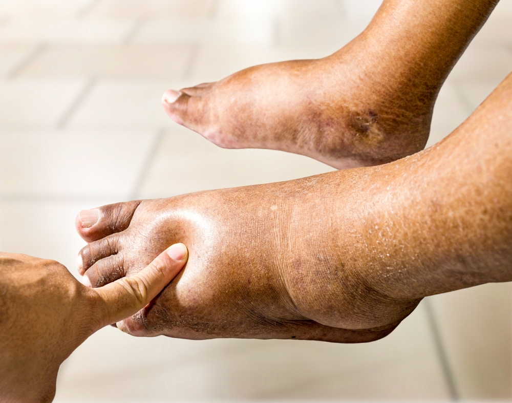 Swelling in Hands, Feet, or Ankles