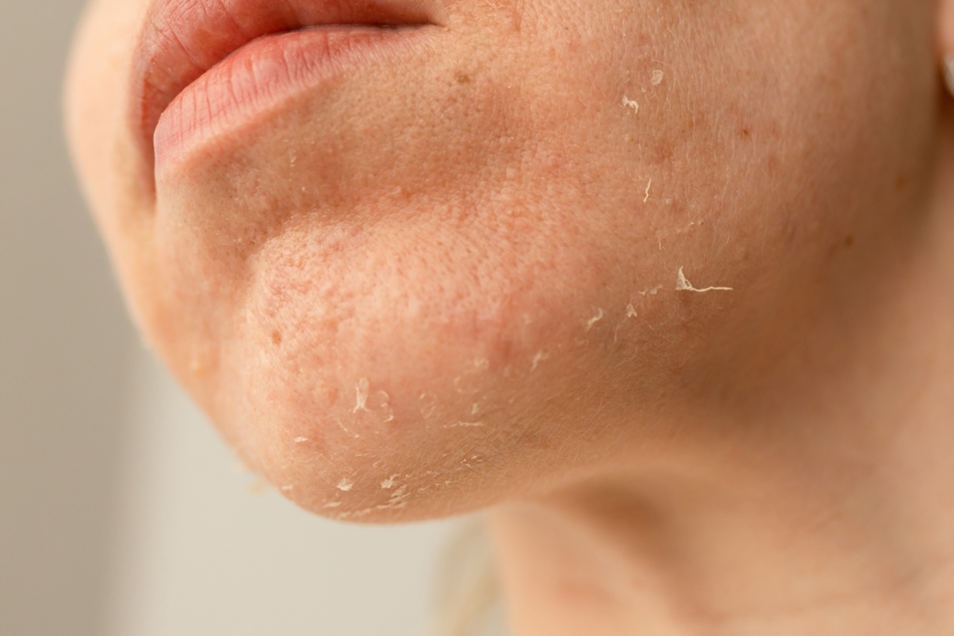 Treat Dry Spots, Not Just the Whole Face
