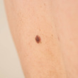 How to Know if Your Moles Could Be a Sign of Skin Cancer