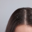 12 Natural Remedies for Dandruff