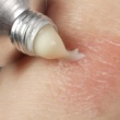 11 Simple Home Remedies for Eczema Relief