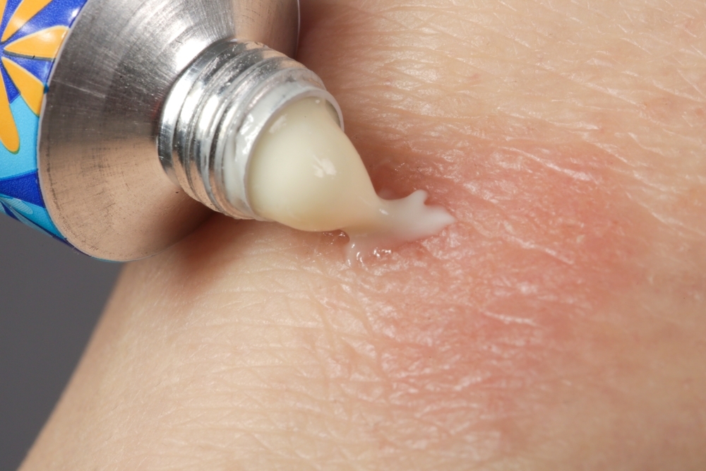 11 Simple Home Remedies for Eczema Relief