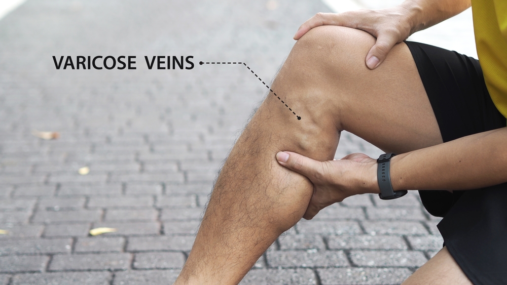 Your Veins Might Be Working Overtime