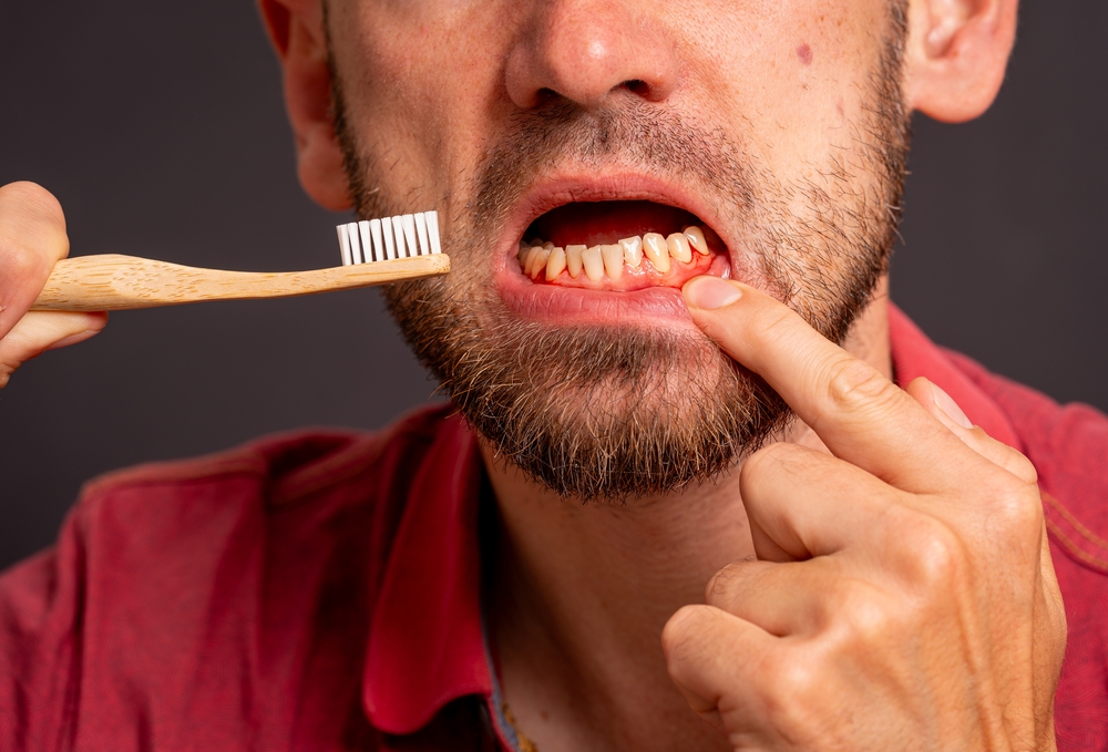 Tooth Decay and Gum Disease