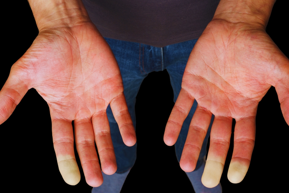 Poor Blood Flow (General Circulation Issues)