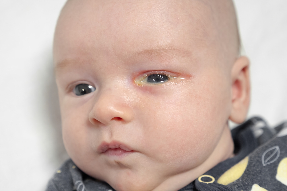 Increased Mucus Production